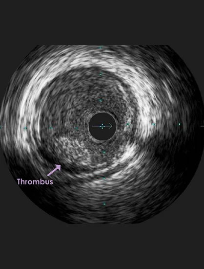 Preparing for the IVUS Procedure