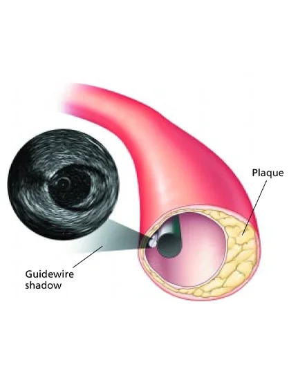 Post Procedure Care