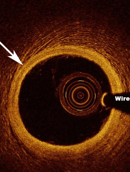 Optical Coherence Tomography Procedure