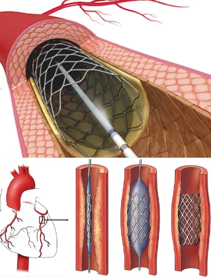 PCI