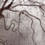 PCI