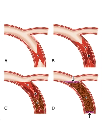 PCI