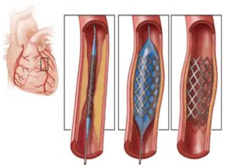 Pathophysiology