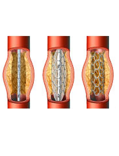CTO PCI Procedure
