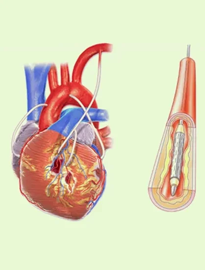 Stress Test and PTCA