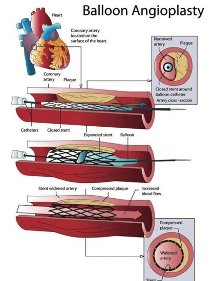 Laser Balloon Angioplasty Catheter