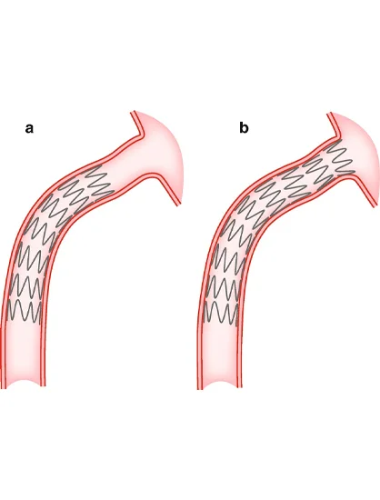 Aorto-Ostial Lesions