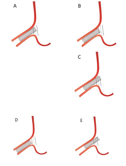 Pre-Procedural Imaging