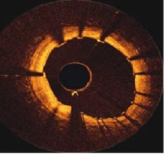 Post CABG Procedure