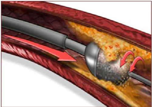 Rotablation Procedure