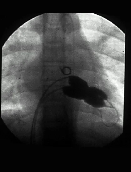 TAVR Overview
