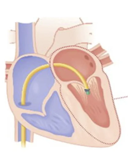 Heart Valve Types and Treatment Conditions