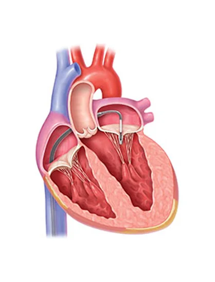 Transcatheter Aortic Valve Replacement