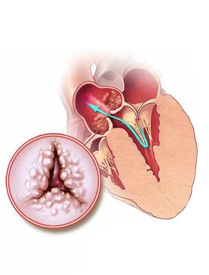 Balloon Valvuloplasty