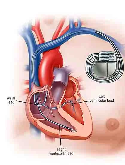 Pacemaker
