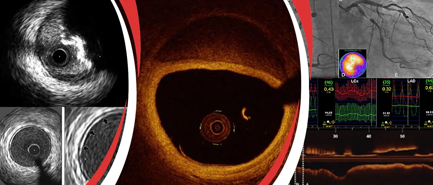 Chronic Total Occlusions