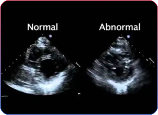 Aorto-Ostial Lesions