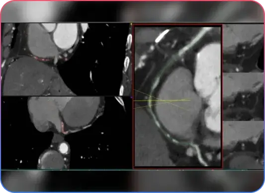 Aorto-Ostial Lesions