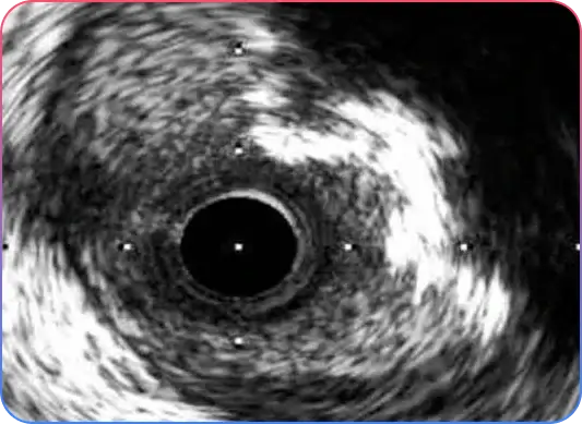 Aorto-Ostial Lesions