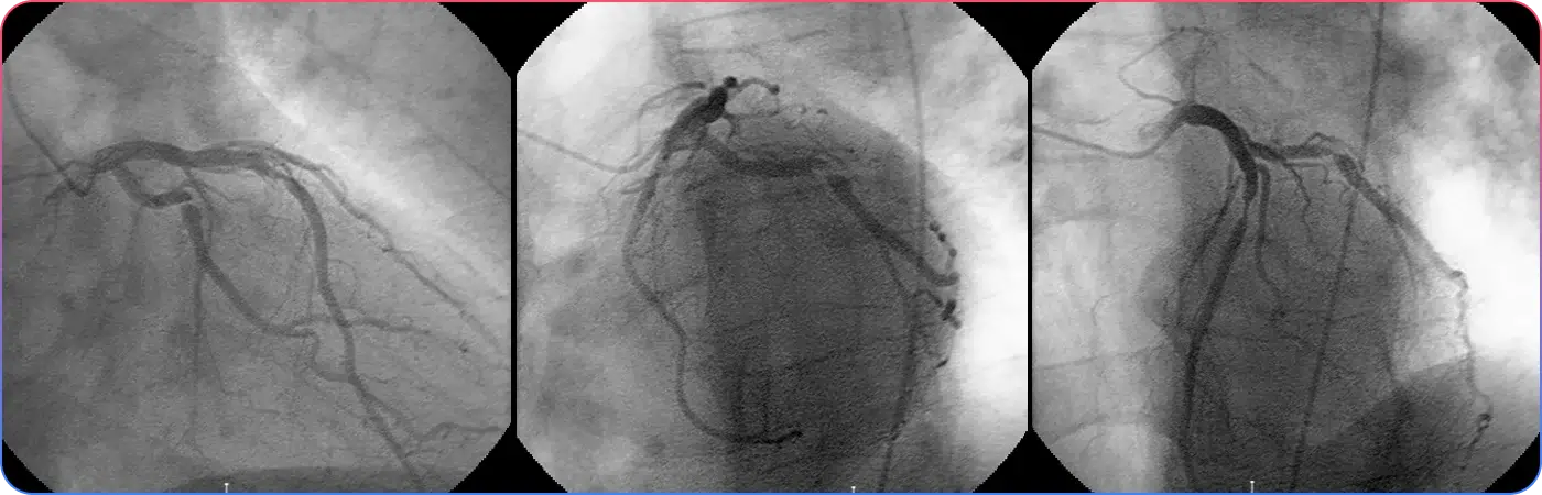 Intravascular Ultrasound Ivus