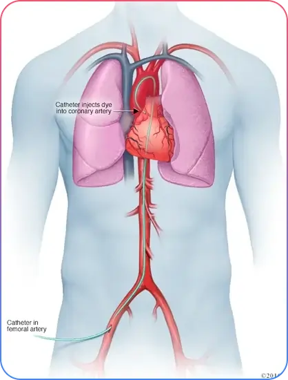 Coronary Angiogram Information