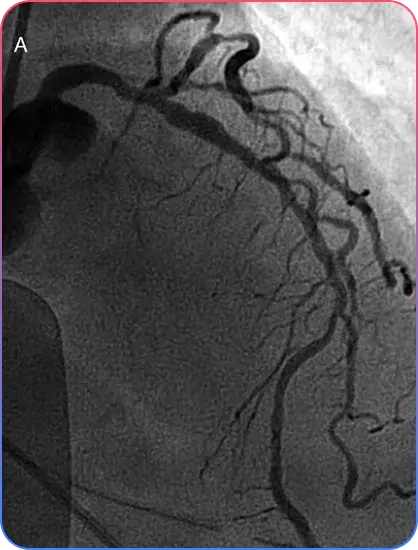 Coronary Angiogram Discomforts