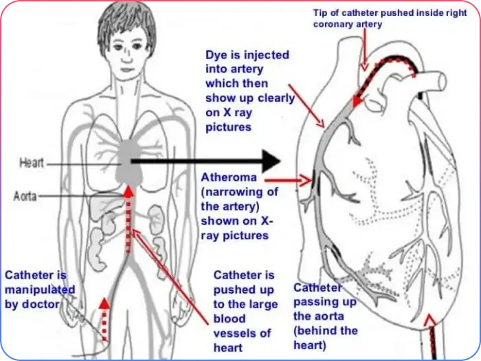 After Coronary Angiogram Procedure