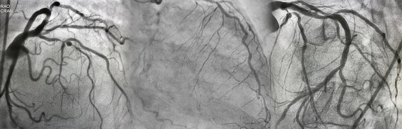 Bifurcation Lesions
