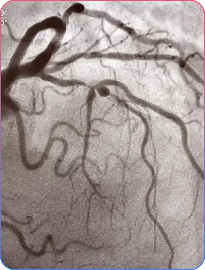 Bifurcation Blockage and Stent