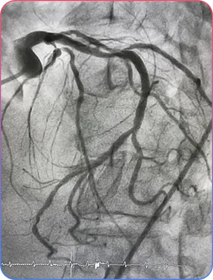 Left Main Bifurcation Procedure