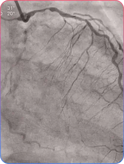 Two-Stent Approach Techniques