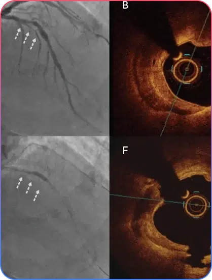 Bifurcation Blockage and Stent