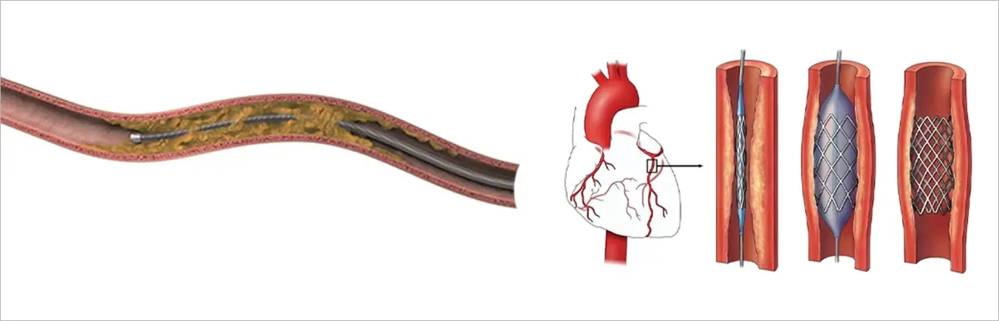 Chronic Total Occlusions