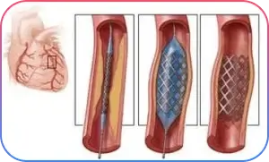 Left Main Bifurcation Procedure