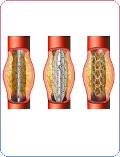 CTO PCI Procedure