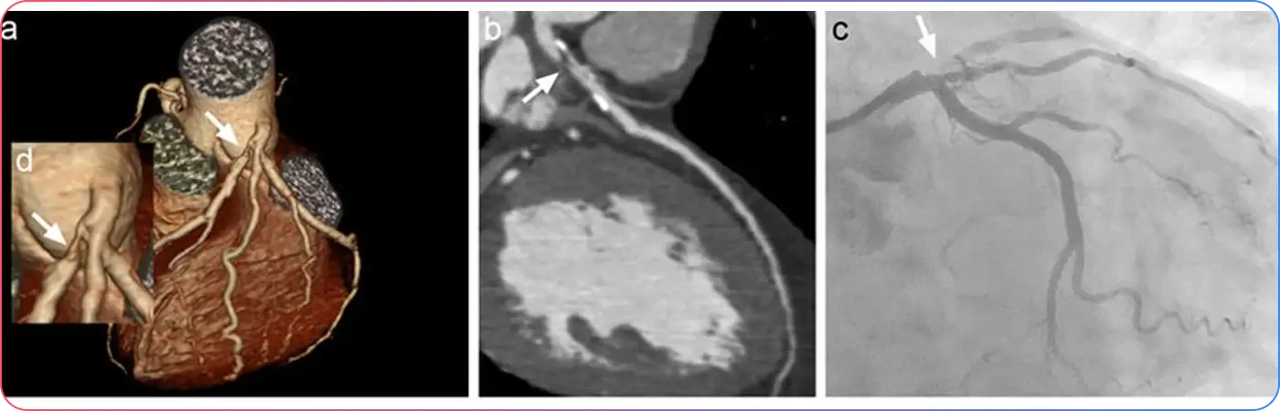 Chronic Total Occlusions