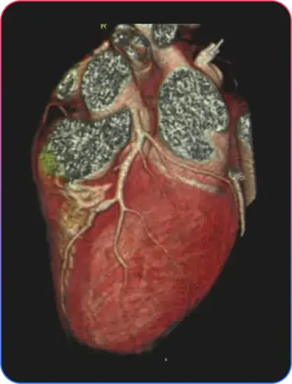 CT Angiogram Information