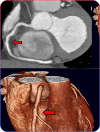 Aorto-Ostial Lesions