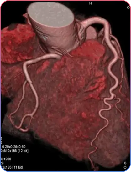 Aorto-Ostial Lesions