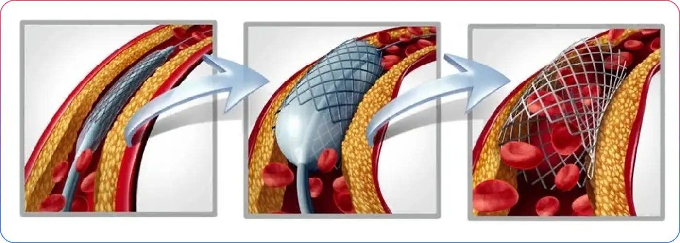 Failed Angioplasty Treatment