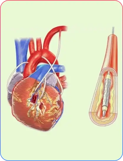 Stress Test and PTCA Information