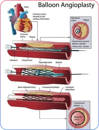 Aorto-Ostial Lesions