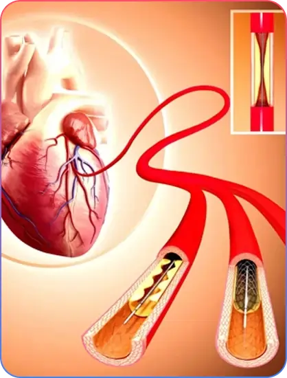 Aorto-Ostial Lesions