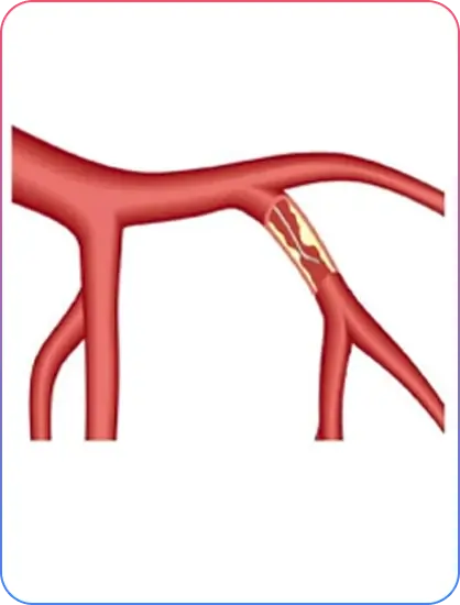 Aorto-Ostial Lesions