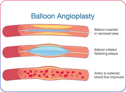 Balloon Angioplasty