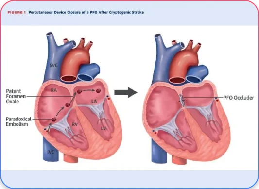 Balloon Angioplasty