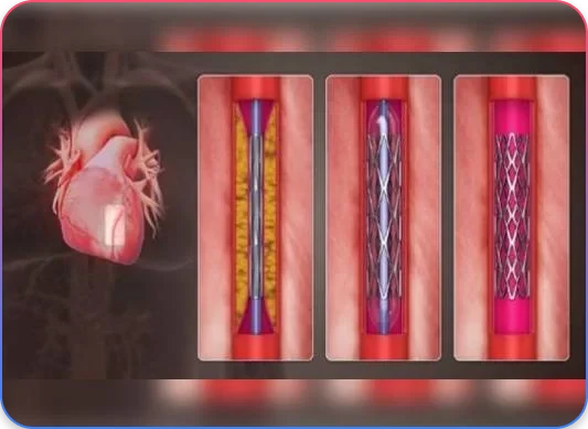 PCI