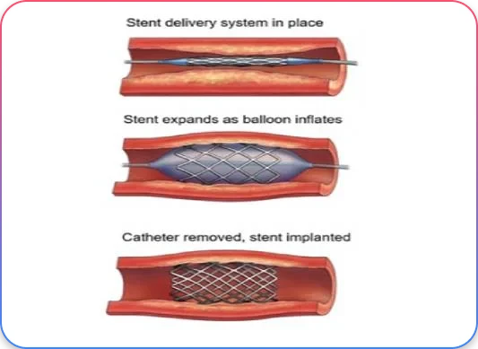 Balloon Angioplasty