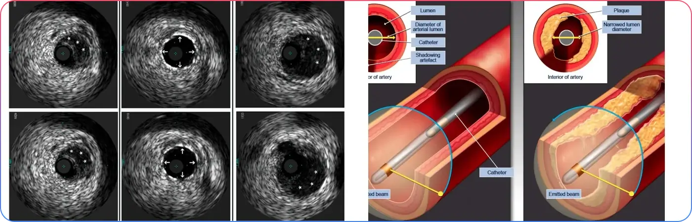 Intravascular Ultrasound Ivus