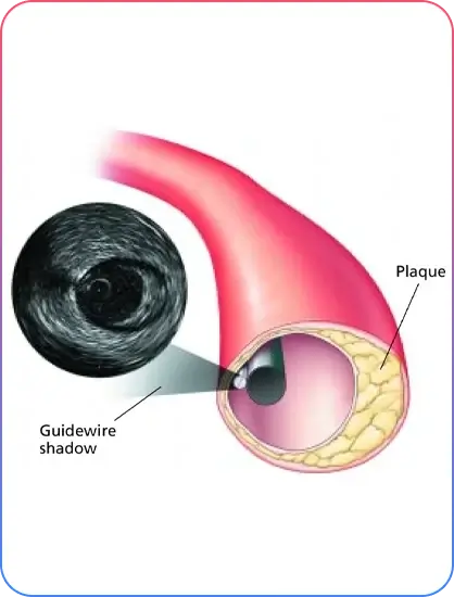Pre Procedural Imaging